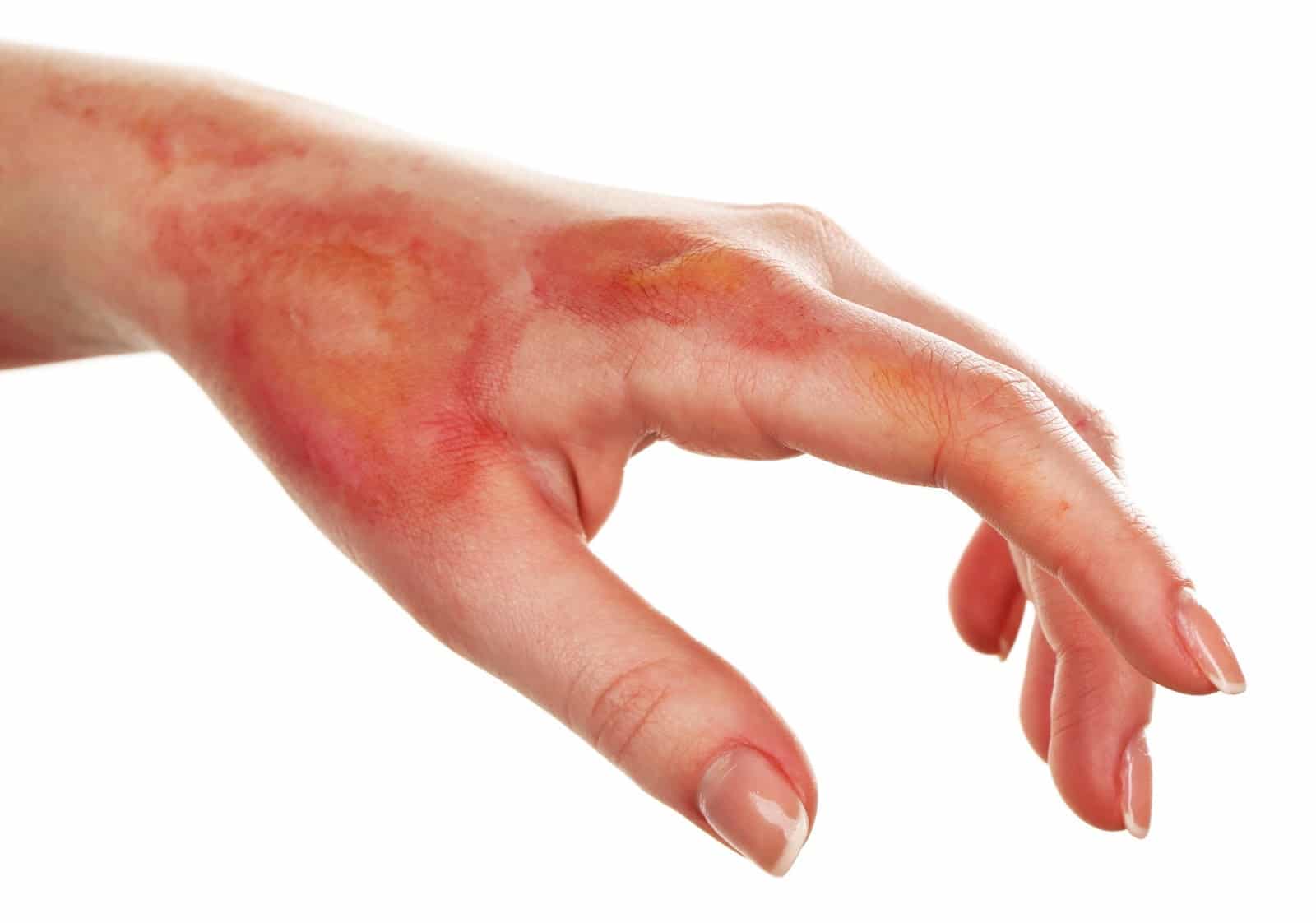 A Guide to Treating your Burn or Scald First Aid for Life